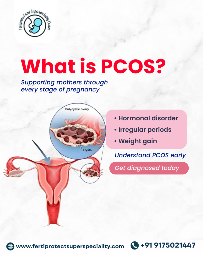 Illustration explaining PCOS with polycystic ovaries, hormonal imbalance, irregular periods, and weight gain awareness for women’s health.